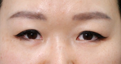눈밑지방재배치레이저 후 회복기간