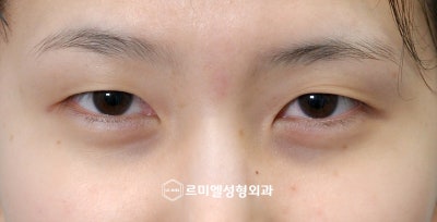 수험생 눈성형 2024 수능 이벤트 사진 4