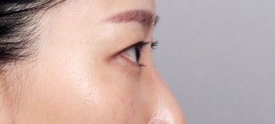 20대 눈밑지방재배치 망할까 망설여지면 보세요 사진 6