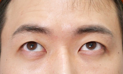 남자 절개 눈매교정? 돈 버리지 마세요 사진 3