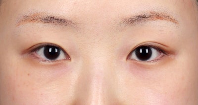 과거 눈밑지방이식 후 제거한 사례 사진 2