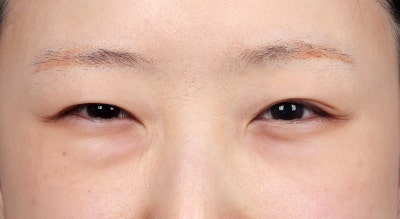 과거 눈밑지방이식 후 제거한 사례 사진 3