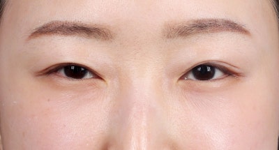 과거 눈밑지방이식 후 제거한 사례 사진 5