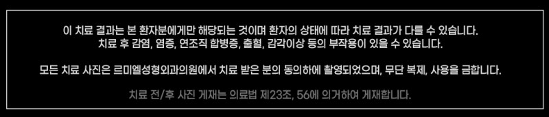듀얼트임(뒤밑트임) 수술 방법 및 주의사항 사진 16