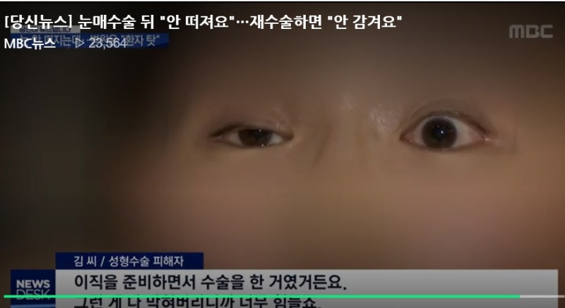 절개눈매교정 부작용 절개눈매교정 합병증 위험성