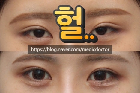 소세지눈 쌍수 소세지눈 재수술