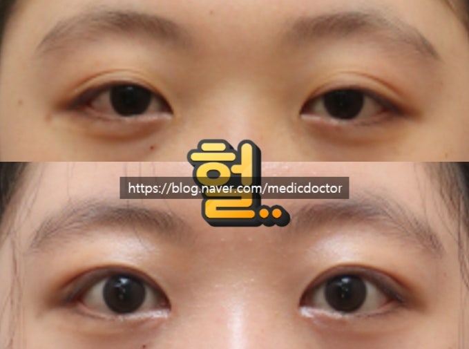 눈매교정눈두덩이 두꺼워짐 해결방법