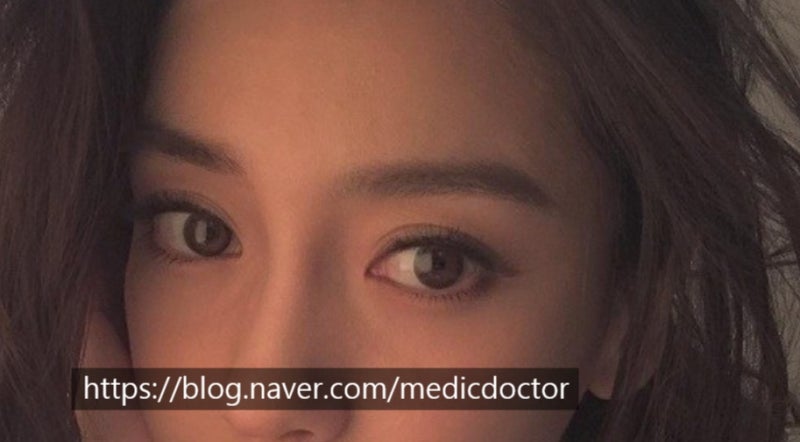 자연스러운 아웃라인 쌍꺼풀 만들기 발표 ㅡ 아시안 눈성형포럼 2019