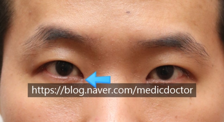 남자 짝눈 교정은 남자무쌍눈매교정으로 수술
