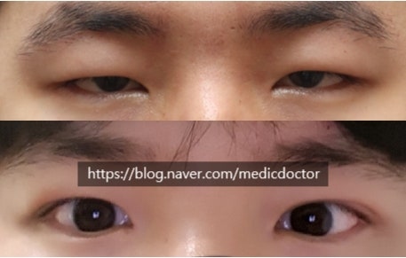 非切开眼型矫正副作用：哪些情况不适合做埋线法？
