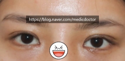 절개눈매교정 풀기 조기 교정하는 경우 - 빠른 재수술 (합병증 예방)