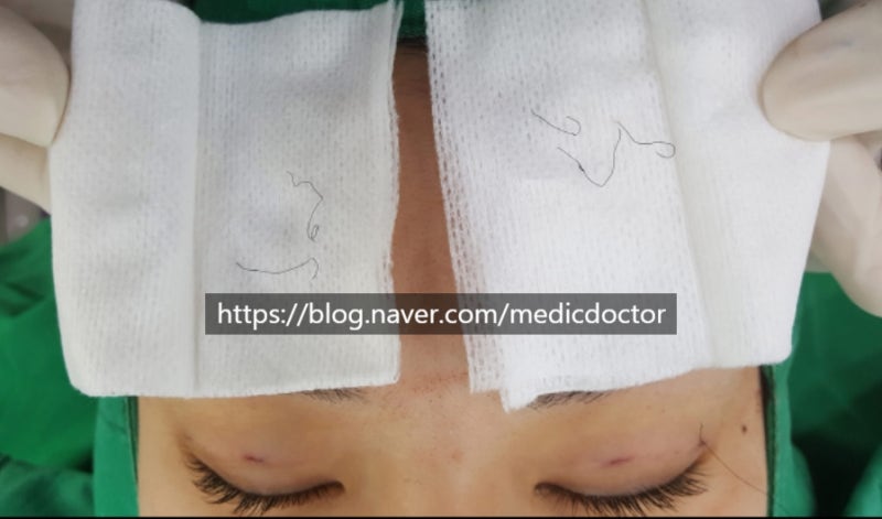 매몰법 풀기 , 쌍꺼풀 풀기 후 붓기