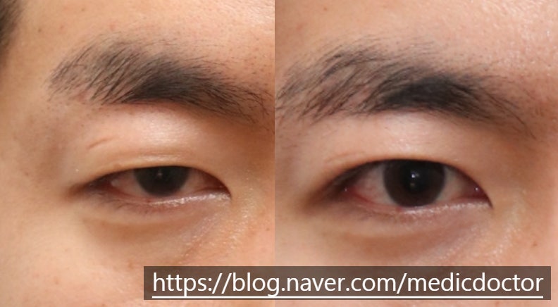 남자 비절개 눈매교정 하면 안되는 이유와 부작용