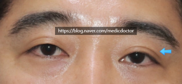남자쌍꺼풀 없애기 수술 치험례 쌍꺼풀제거 수술