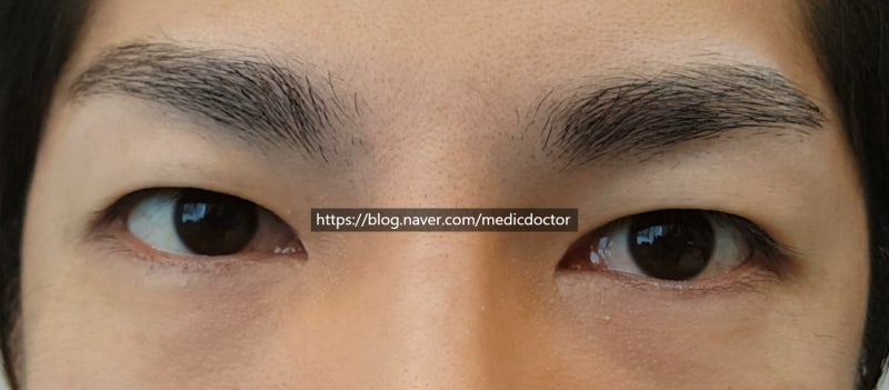 Hồi ký 1 tuần sau phẫu thuật phục hồi khóe mắt trong: Tình trạng sưng và tiến triển