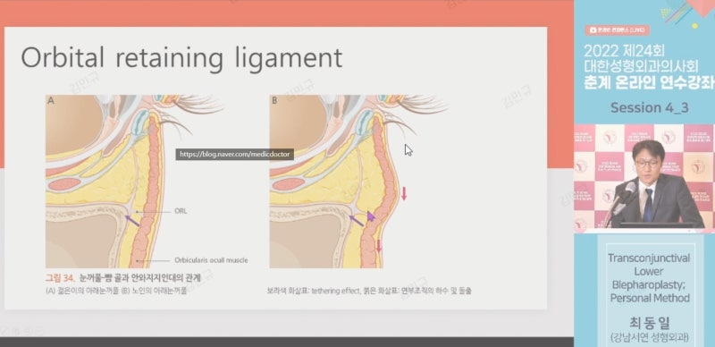 눈밑지방 재배치 통증 덜하게 하려면?
