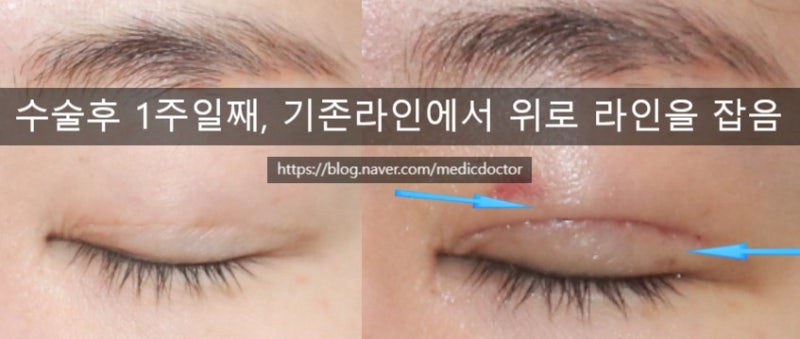 쌍꺼풀 라인높이기 (인(in) -> 인아웃(in-out))등 변경