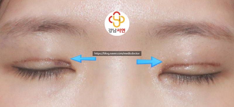 절개 눈매교정 눈당김 풀기