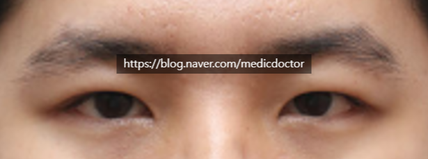 How to Enlarge Eyes Without Ptosis Correction (feat. Monolid Ptosis Correction for Men?)