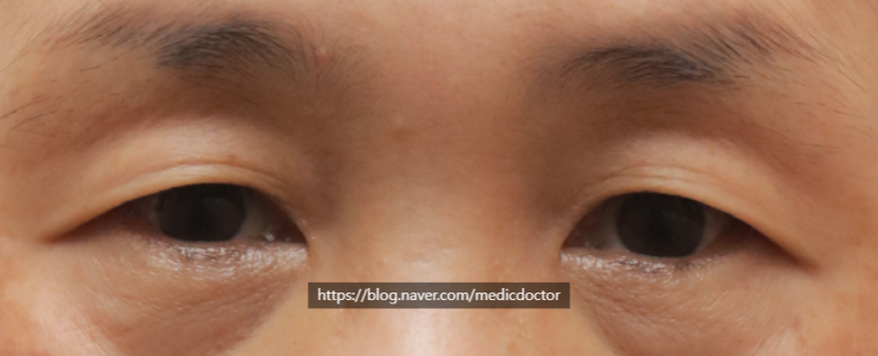 Wrinkles Around the Double Eyelid (Aging Wrinkles, Multiple Folds): Upper Blepharoplasty for Ages 40 and Above