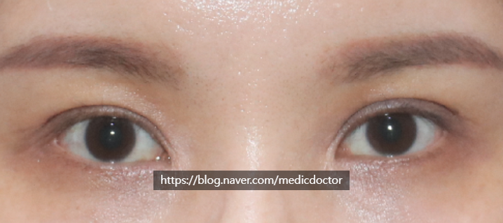 Changing Out-fold Double Eyelids to Semi-out Folds (feat. Double-Line Incision)