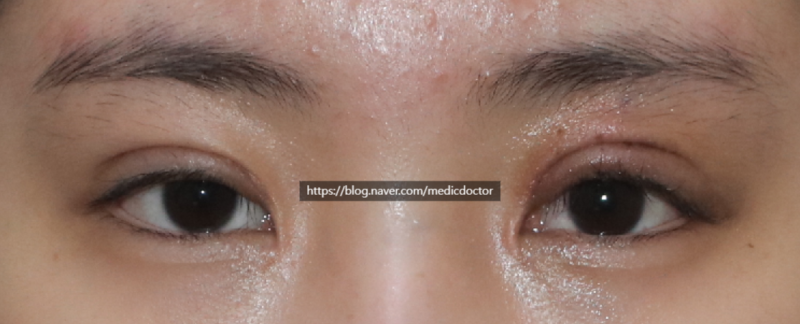 Ptosis Correction Side Effects and Complications (feat. Long-term Progress, CFS Surgery, Early Revision)