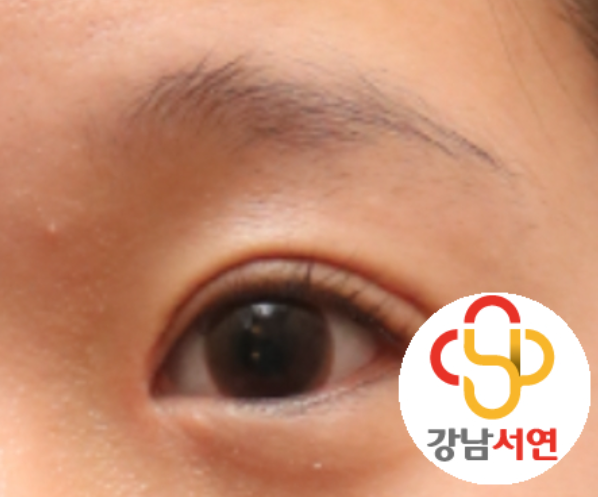 두줄따기(?) 수술을 하지 말라고?? 두줄따기 수술은 하면 안되는 수술?