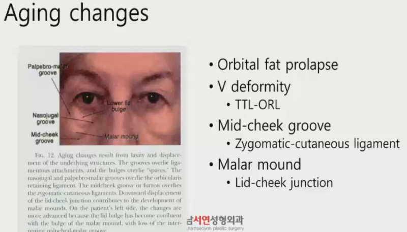 눈밑지방재배치 강의 EZ-Tcon 웨비나(webinar) 한스바이오메드 협찬 (다크써클, 눈밑지방, 하안검)