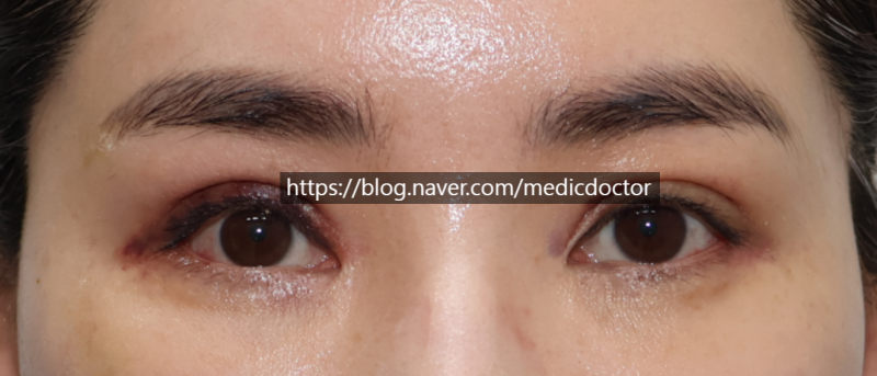 When is the Best Time for Early Double Eyelid Revision? (feat. Early Lateral and Lower Canthoplasty Revision)