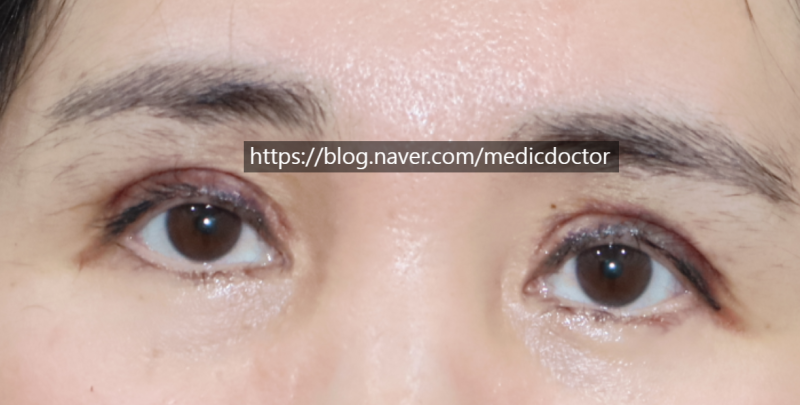 Early Correction for Multiple Eyelid Folds (Case Study: Improving Multiple Folds and Sunken Eyelids After Two Failed Early Corrections at Other Clinics)