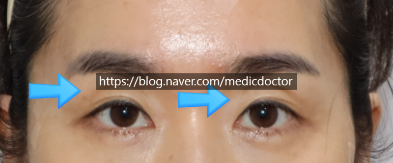 Cấy ghép mỡ vùng mắt và cải thiện sụp mi, tiến triển sưng sau cấy ghép mỡ nano