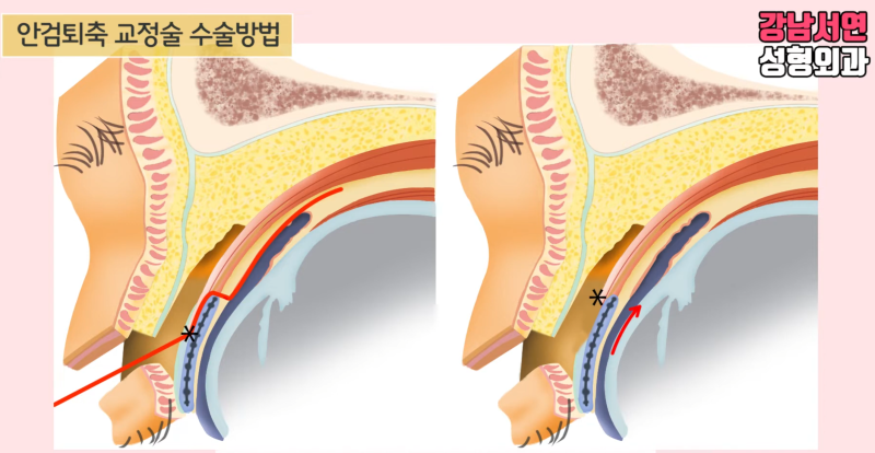 안검퇴축술이란? 과교정된 눈매교정 재수술 A to Z | 강남서연성형외과 안검퇴축 재수술 사진 4
