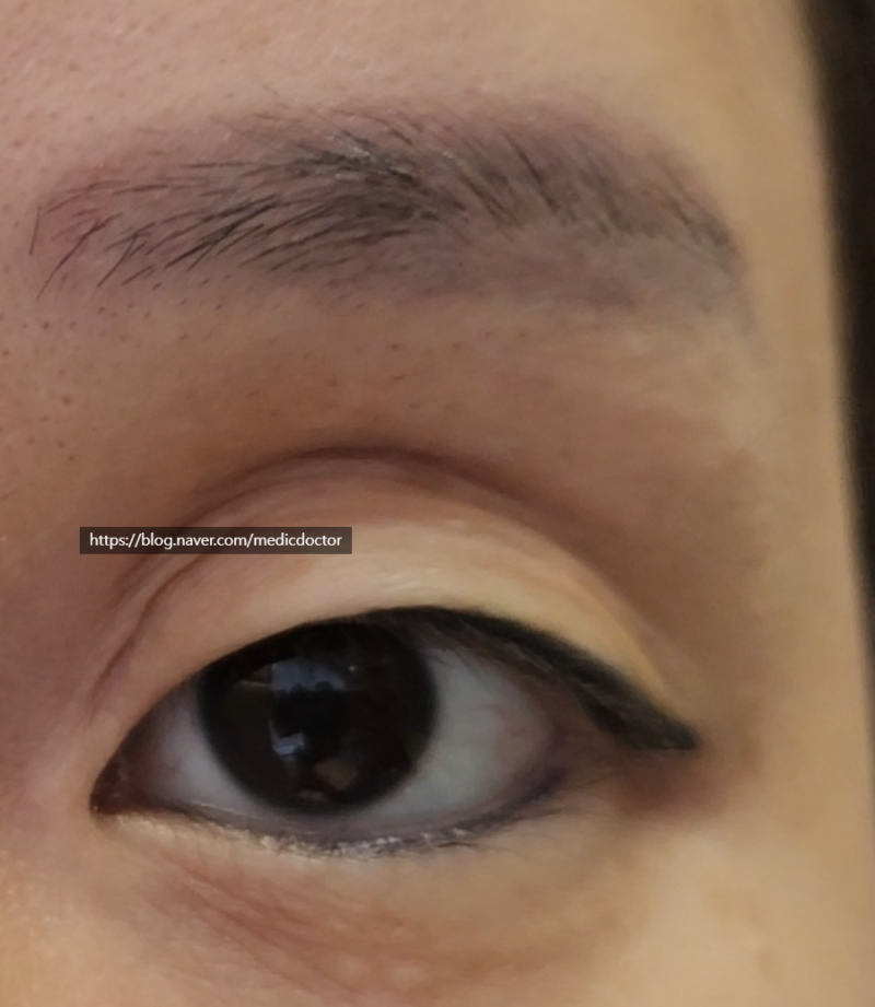 눈위 꺼짐 치료 눈두덩이 지방이식,눈위 지방꺼짐 두줄따기 사진 2