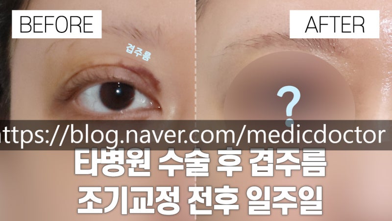 절개법 쌍꺼풀 조기교정, 필요한 경우와 접근 방법