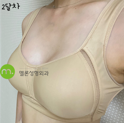 가슴성형 6개월 차, 모티바 풀 375cc의 모양은?