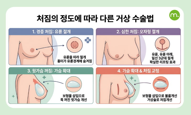 강남 가슴거상, 축 처진 나를 위한 가슴 리프팅