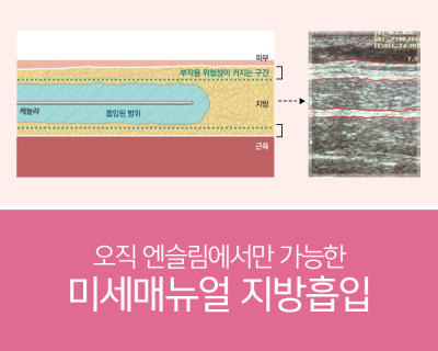 강남 전신지방흡입병원 후기 많은 곳? 사진 6