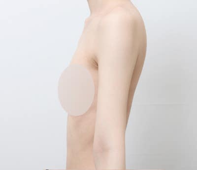 팔 지방흡입, 팔뚝 살이 고민이시라면 알아두세요! 🙂 사진 9