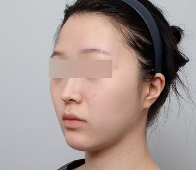 얼굴지방이식, 자연스러운 볼륨을 위한 방법 🌿 사진 3