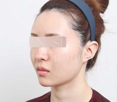 실제 환자 전후로 보는 얼굴 지방이식 변화 사진 3