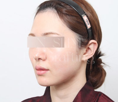 실제 환자 전후로 보는 얼굴 지방이식 변화 사진 2
