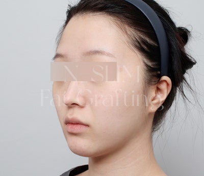 실제 환자 전후로 보는 얼굴 지방이식 변화 사진 11