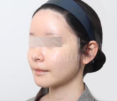 실제 환자 전후로 보는 얼굴 지방이식 변화 사진 7