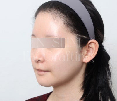 실제 환자 전후로 보는 얼굴 지방이식 변화 사진 6