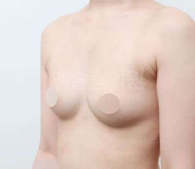 가슴지방이식 자연스럽게 채우기 (+실제사례) 사진 10