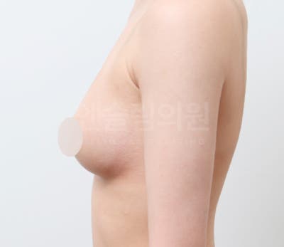가슴지방이식 자연스럽게 채우기 (+실제사례) 사진 13