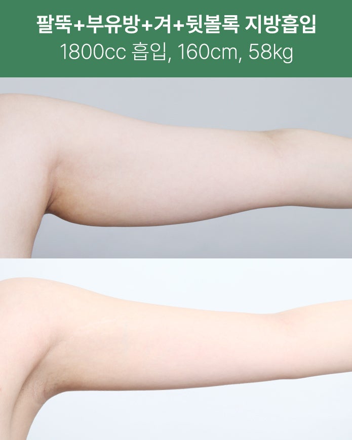 팔뚝·부유방·겨드랑이까지 1800cc 지방흡입 사진 5