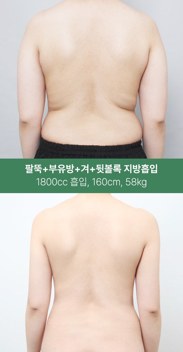 팔뚝·부유방·겨드랑이까지 1800cc 지방흡입 사진 4