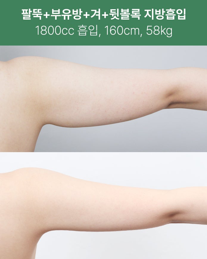 팔뚝·부유방·겨드랑이까지 1800cc 지방흡입 사진 6