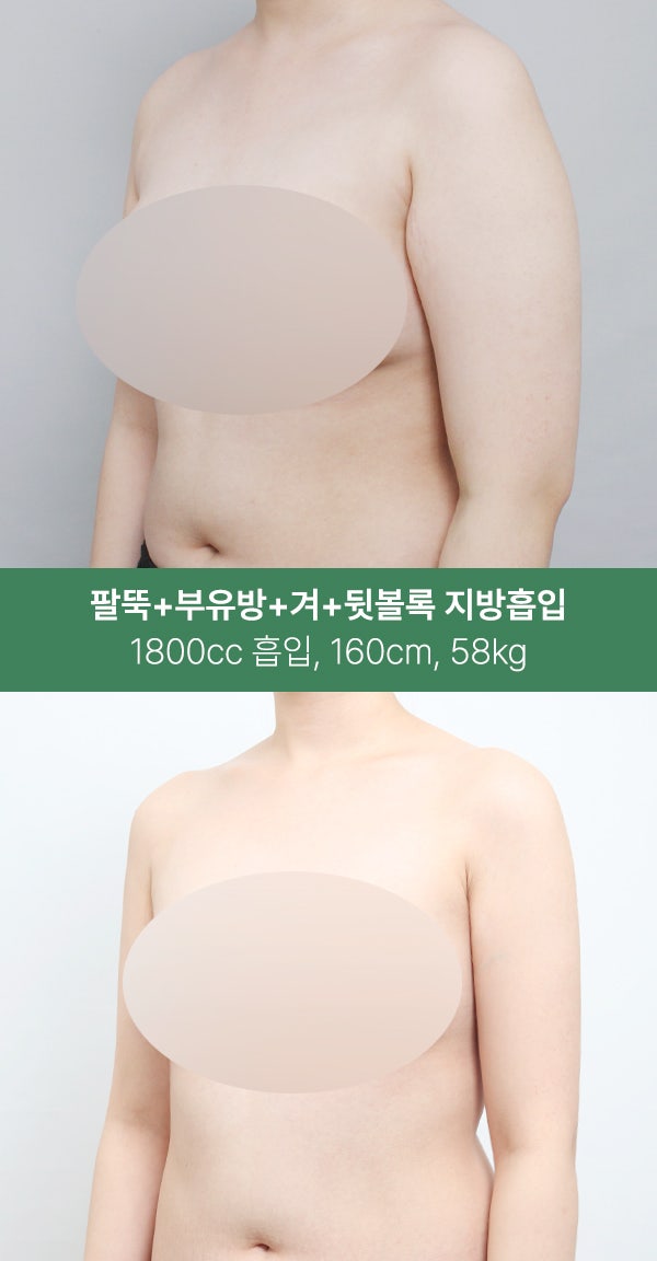 팔뚝·부유방·겨드랑이까지 1800cc 지방흡입 사진 2